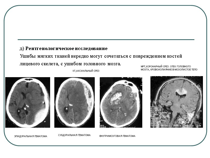 д) Рентгенологическое исследование Ушибы мягких тканей нередко могут сочетаться с повреждением костей  лицевого